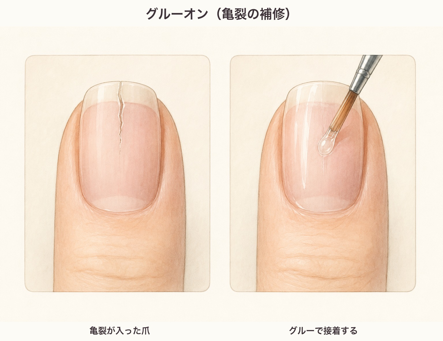 グルーオンの図。亀裂が入った爪に、ネイルグルーを塗布して接着する