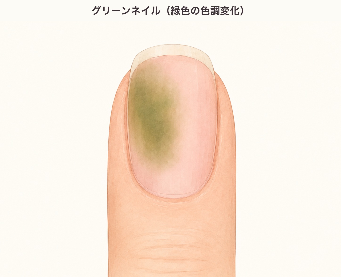 緑色に変色した爪の図。緑膿菌感染（グリーンネイル）による不規則な緑色の色ムラ