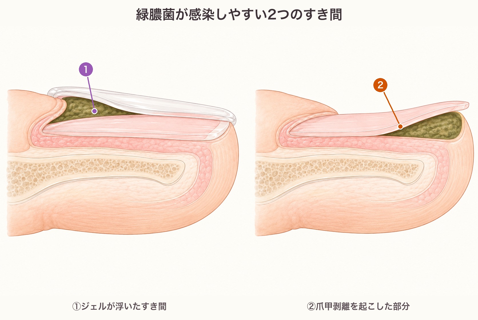 緑膿菌が感染しやすい2つのすき間の断面図。ジェルが浮いたすき間と、爪甲剥離を起こした部分